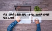 手足口病症状初期图片（手足口病症状初期图片怎么治疗）