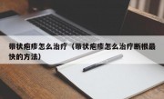 带状疱疹怎么治疗（带状疱疹怎么治疗断根最快的方法）